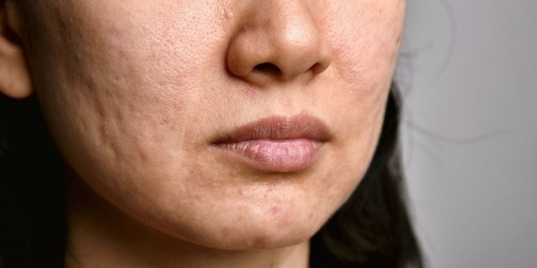 ACNE EN ADULTOS 