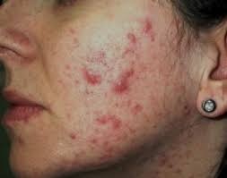 ACNE EN LA MUJER ADULTA